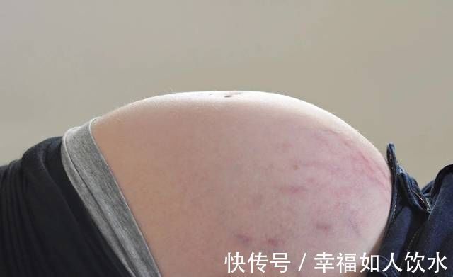 腹带|同是孕妇有人不长妊娠纹?有四个特征的孕妈不会被妊娠纹困扰