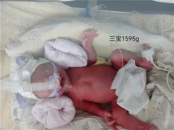 三胞胎|全国首例！新冠确诊孕妇诞下三胞胎