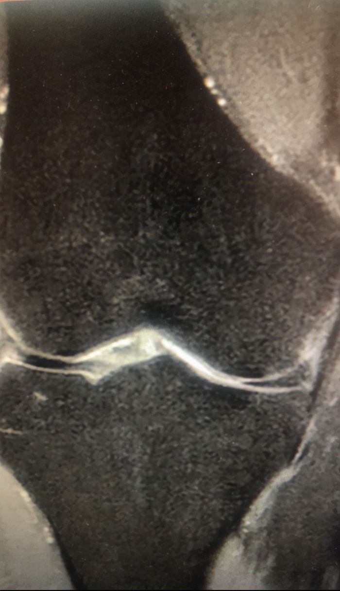 疼痛|膝关节疼痛不愿就医！硬抗2年，医生发现：原来不仅是关节炎