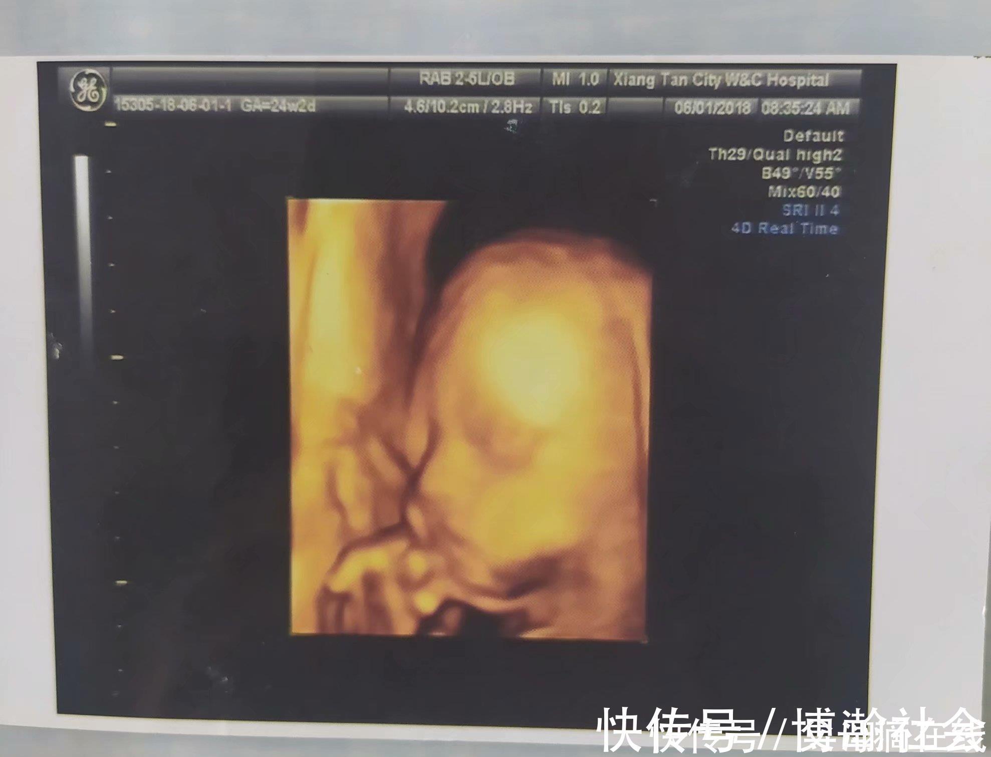 妈妈们|孕期大排畸检查,快速通过及注意事项,你想知道的都在这里