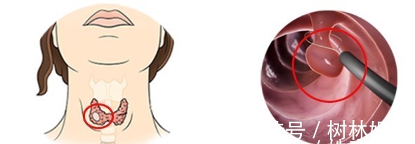 科室|结节、息肉、囊肿、增生哪个最可能癌变这么多年疑惑终于解开了