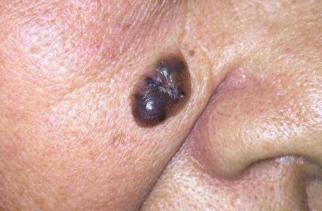 黑素细胞|黑痣只要不长在此处,很难变“癌症”!别再自己吓唬自己了