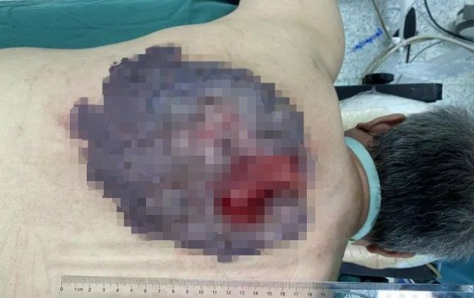 椎体|男子胎记越长越大,最后瘫痪