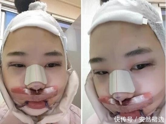 疼痛|小脸确实更可爱,看完整容过程,只觉得满屏的疼痛