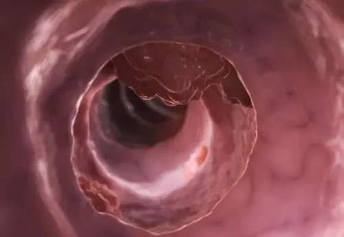 肠清茶|52岁李女士花费10万治便秘,却养出肠癌前病变,早知早受益