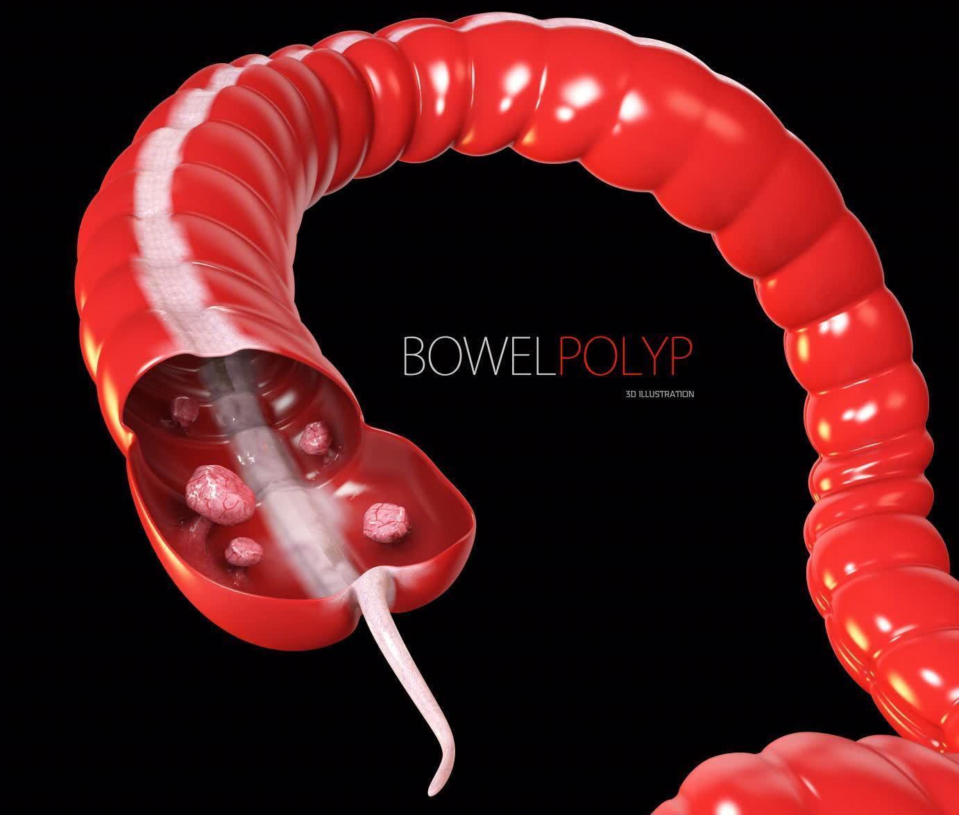 结肠癌|会癌变的肠息肉越来越多,1个习惯是凶手!医生奉劝赶快远离