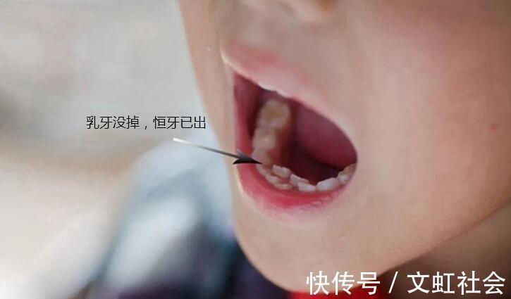 双排牙|最全儿童换牙时间表:儿童换牙何时开始、何时结束?一图说清