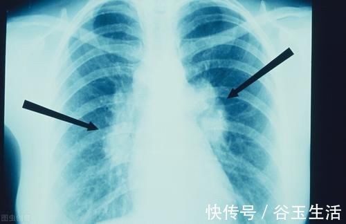 二手烟|肺结节为什么越来越多，发现后怎么办？生活上应该注意什么？