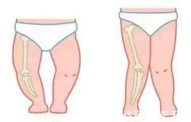 孩子|天使科普:孩子站早了,腿会不会变形?