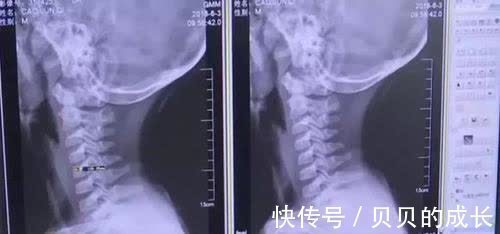 颈椎病|孩子一年来一直做一件事,妈妈发现后立刻送医,医生却说:来晚了