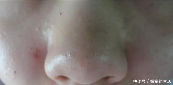 氨基酸洗面奶|先别慌着挤黑头,这3种原因你知道了再挤也不迟!