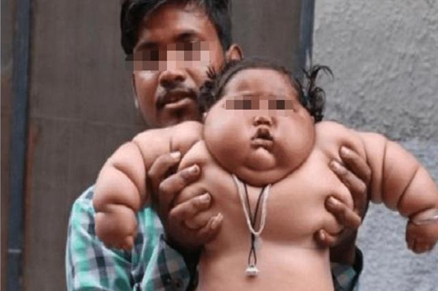 现状|7年了,那个8个月体重45斤,1天吃48顿饭的“巨婴”现状如何