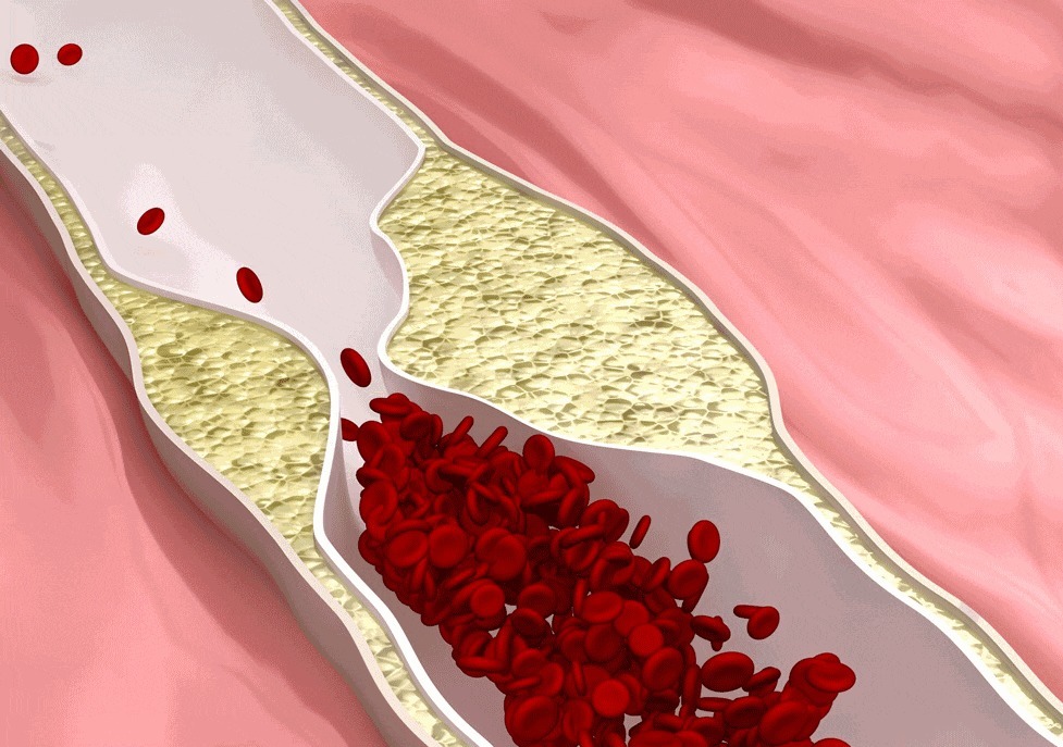 预防血栓|有“血栓”的人,若坚持在4个时刻喝水,有助给血管“洗个澡”