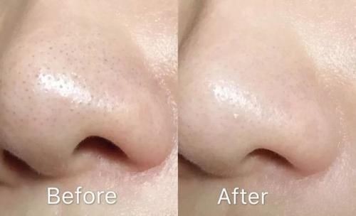 自己在家如何去黑头？这几个“土”方法，大家可以试试