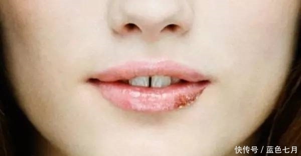 無論男女,如果嘴上出現(xiàn)了“它”,可能是體內(nèi)免疫力要下降了