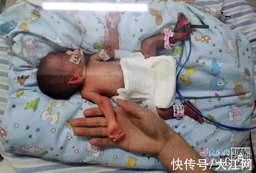 超早产儿|巴掌大的超早产儿奇迹存活
