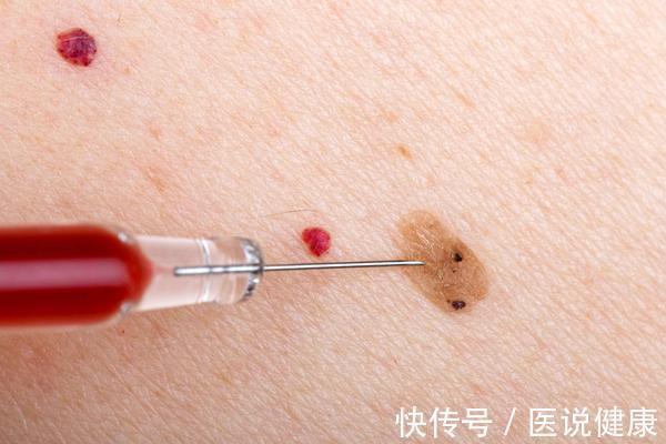 色素痣|皮肤上出现了红痣,还伴随这4种情况,当心是皮肤肿瘤找上门了