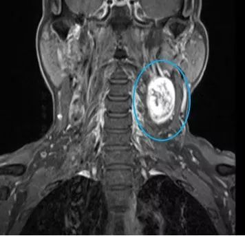 磁共振|医院先后来了两个男子,毛病几乎一样脖子上长了“鹌鹑蛋”,按按手还有触电的感觉……