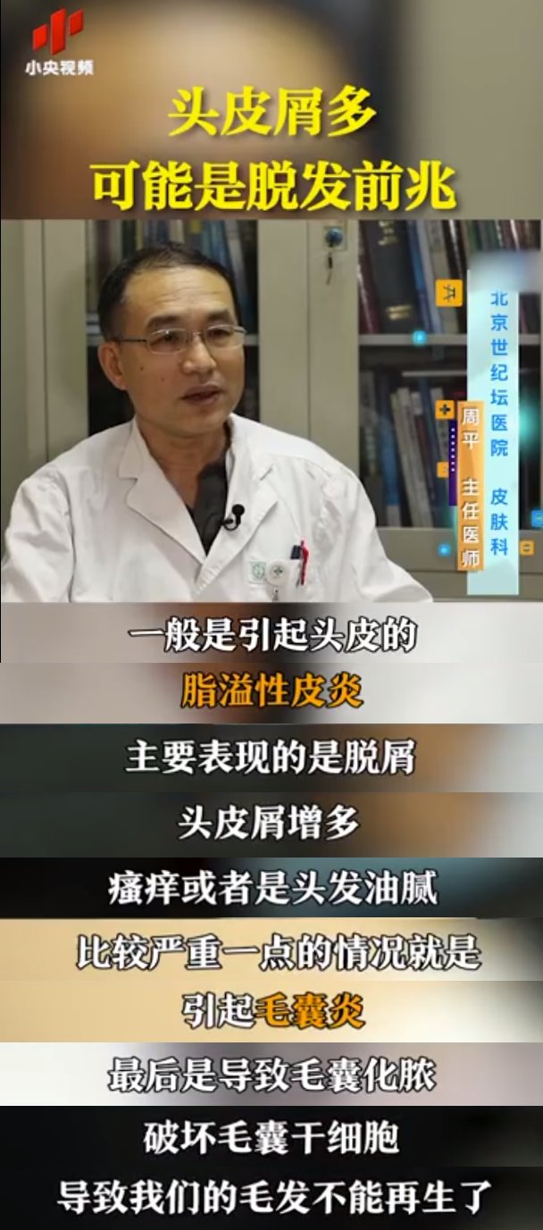 脱发|来自皮肤科医生的警告:头屑多,可能是脱发前兆
