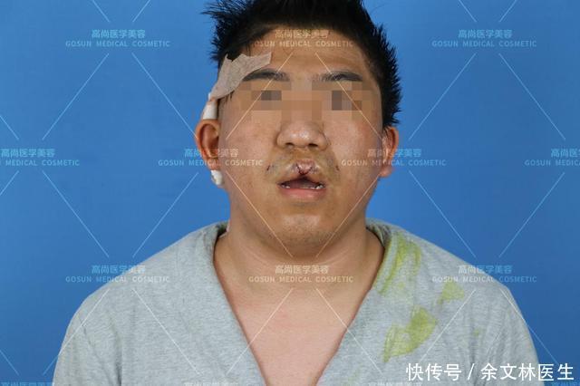 容貌|【案例分享】中年男子也在意相貌?唇裂男子为改善容貌做唇红修复手术
