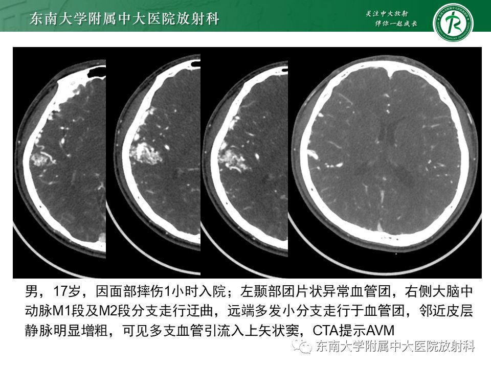 脑动静脉畸形 影像表现