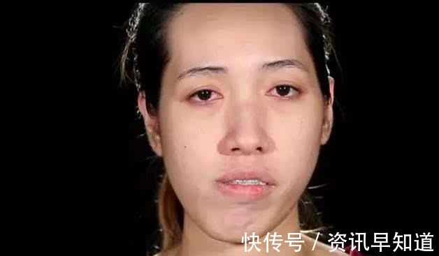 畸形|女子面部畸形像“丑八怪”, 整容后, 成为一名漂亮的女模特