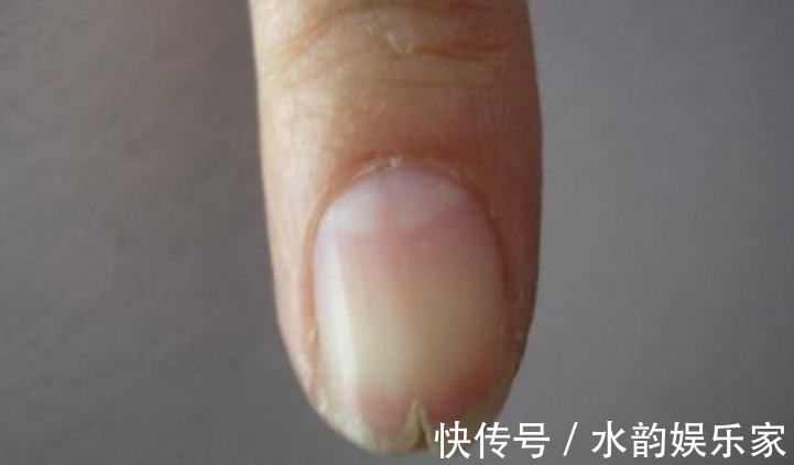 病变|肝脏没有痛觉,发现就是晚期!手上出现3种信号,提示你病变了