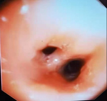 蓝军|都是辣椒尖惹的祸!中国科学院大学重庆仁济医院呼吸与危重症医学科顺利完成支气管异物取出术