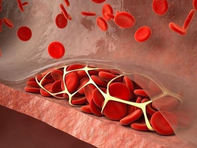 血栓|血栓遇到大克星,3种天然“阿司匹林”,常吃血管通畅保健康