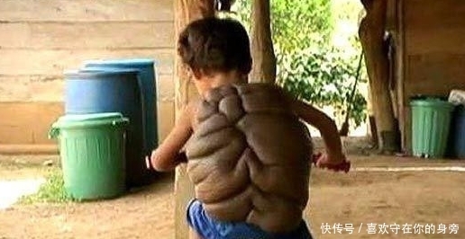 国外一8岁男孩从小身患怪病,每天背着”龟壳“出门