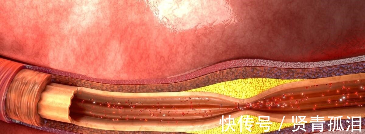 降低|想预防高血脂、降低甘油三酯，几种方法值得学习，不妨了解一下