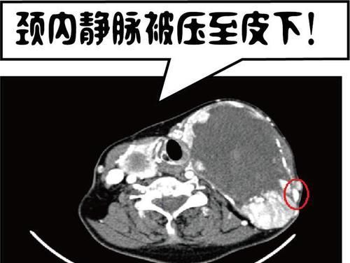 “俩头”在脖子上长了20年！直到喘不上气才看医