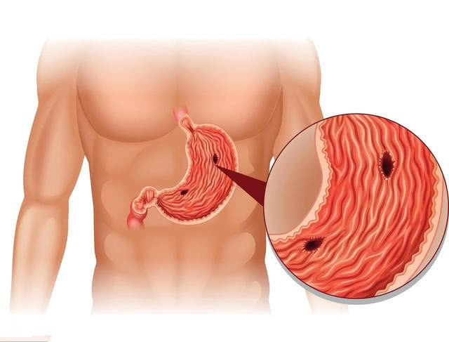 肠镜检查|没熬过46-59岁的人,多是被3种癌症绊住了,希望你健康长寿