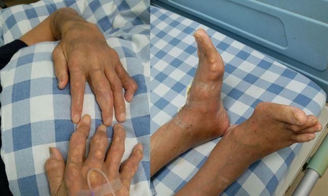 一张只有2味药的痛风治愈方,造福了无数人,从根本上解决痛风