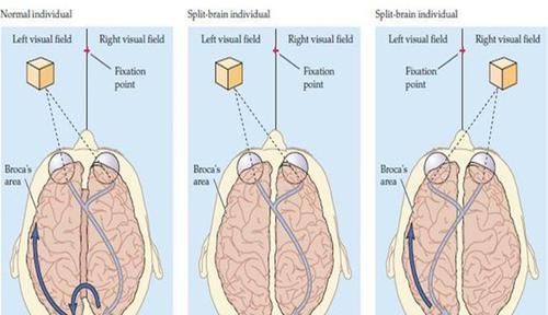 癫痫病|“裂脑人”拥有过人智慧，被认为拥有超能力，其实他们极为痛苦！