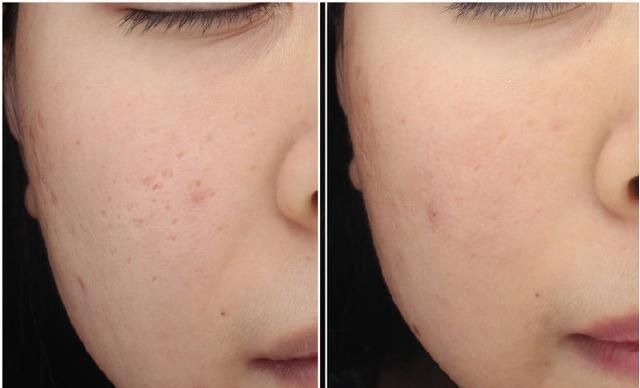 “痘坑”怎样修复,能否选择‘’无恢复期‘’的治疗项目