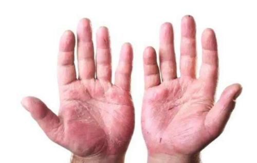 足够的重视|肝脏不好,手会发出3个“警示”,不太明显,多数人都忽视了!