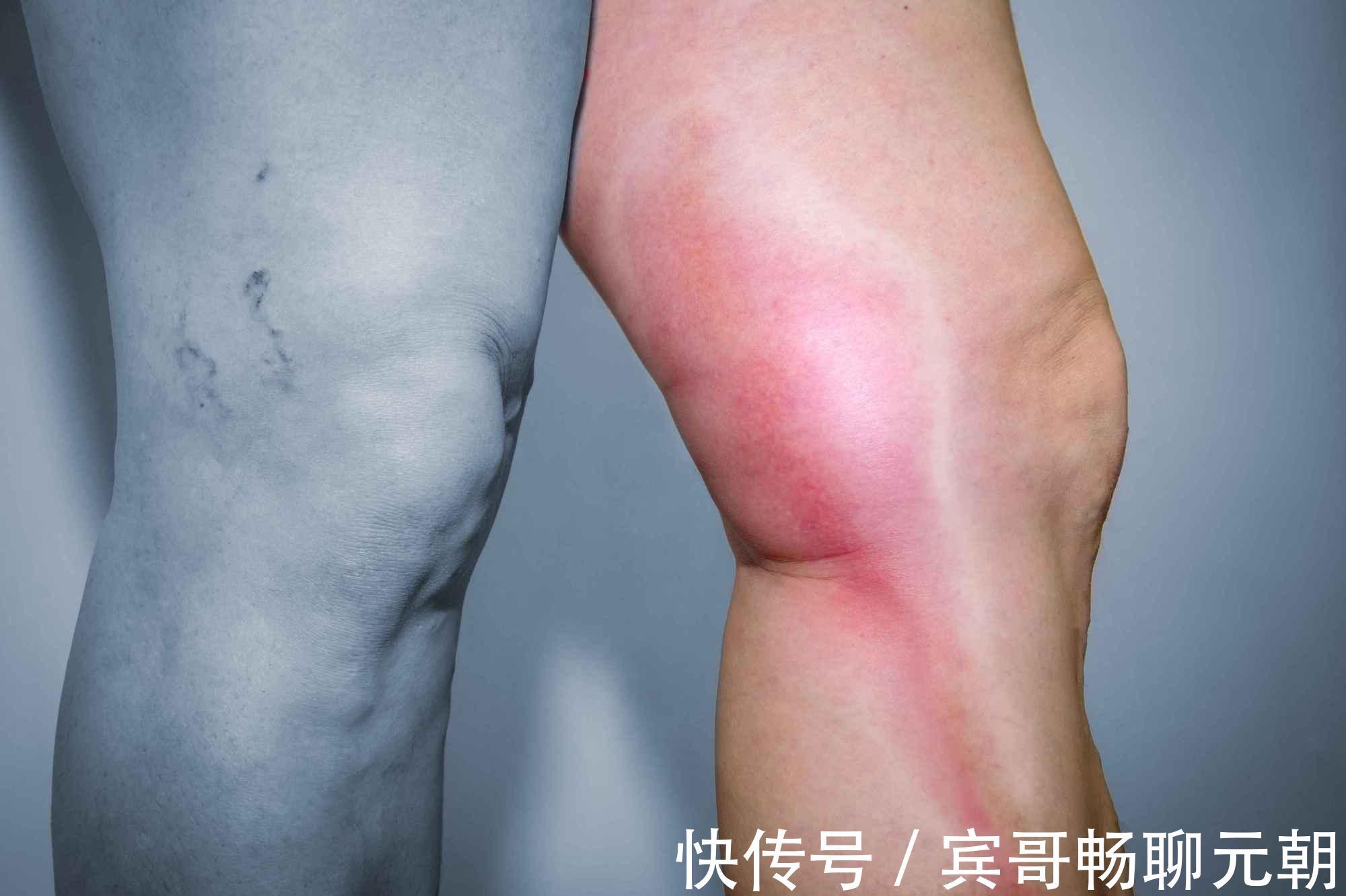 症状|体内有血栓,腿知道!腿部有3个症状,说明血栓已形成,及时揪出