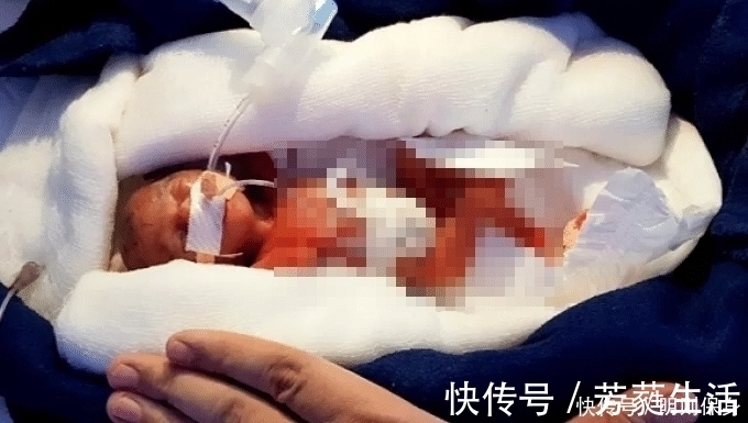 优质蛋白|全球最小“婴儿”体重245克,比手掌还小,6个月过去了现状如何?