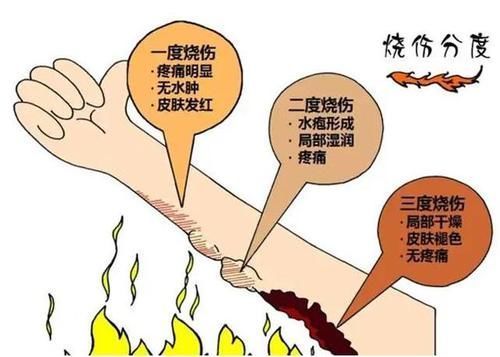 伤口|孩子烫伤后只有2分钟紧急处理,做错这一步,可能加重孩子的伤情