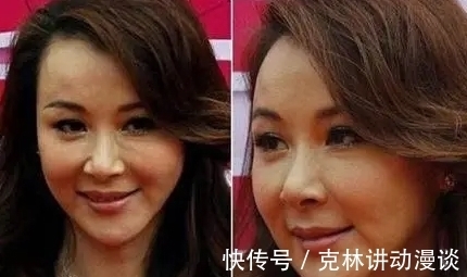 老后脸|整形变老后脸会崩吗是?