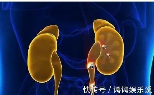 危害|男性患肾结石，都会有哪些难以想象的危害？男性要注意了！