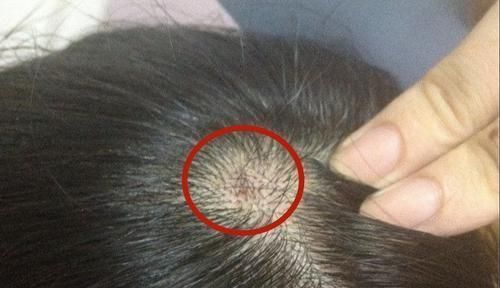 常识|头皮上长出的“小疙瘩”是什么?对身体有影响吗?这些常识要了解