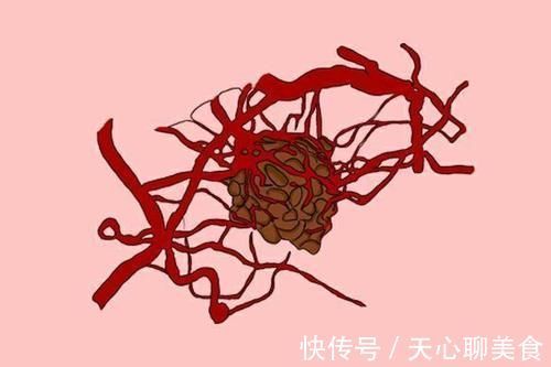 恶性肿瘤|得了癌症,该怎么治疗?医生给出了具体建议,少走点弯路