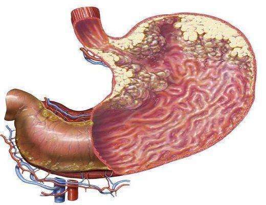 四大名补|送给癌症患者们的“四大名补”食疗方,这才是正确的抗癌方式