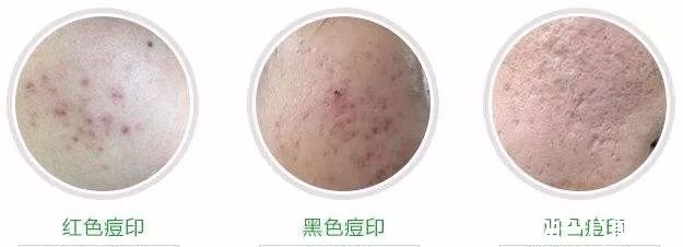 毛孔 小心!以下5个护肤坏习惯,能让你的毛孔越来越大……