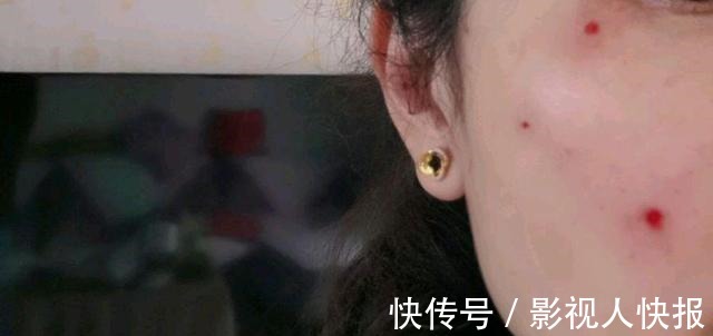 激光祛斑手术 今天到美容院做激光祛斑手术,没用麻药!