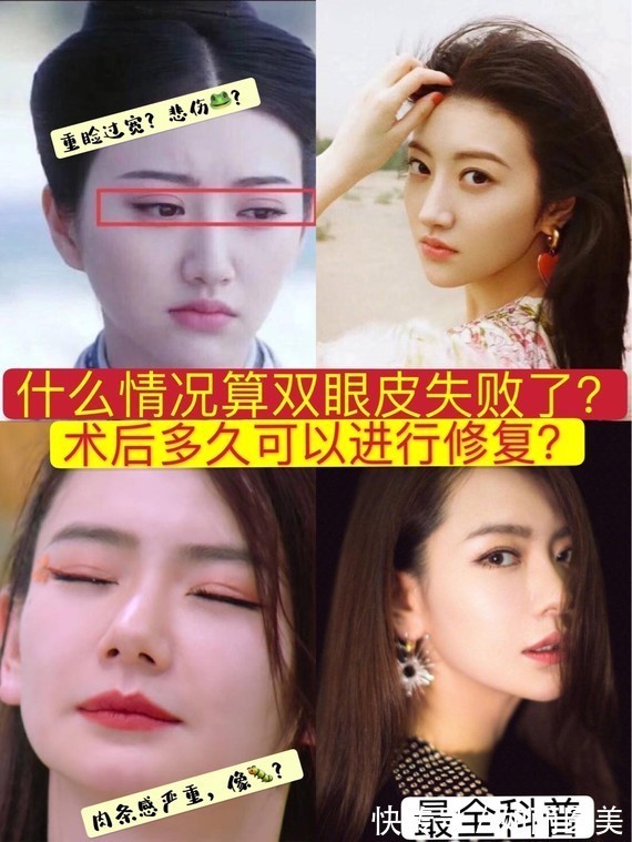 手术 什么样的双眼皮手术意味着失败了?术后多久才能进行二次修复?看完这篇,你就知道啦~