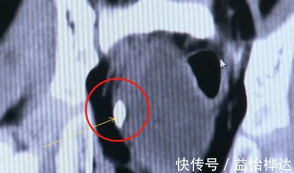 爸妈|5岁女童患尿路结石…送医时已发烧、抽搐、呼吸困难爸妈注意了