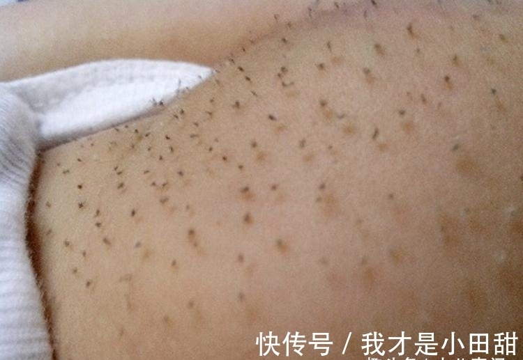 夫妻俩|儿子身上长满了“毒刺”,父母慌忙带到医院检查,医生:愚昧!